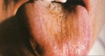 Đi khám gan ngay nếu bạn thấy có dấu hiệu bất thường này ở lưỡi