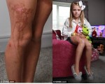 Sử dụng kem chống nắng, cô bé 9 tuổi bị cháy da nghiêm trọng như bị nhỏ axit