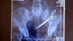 Bắc Kạn: Bác sỹ để quên kéo trong bụng bệnh nhân 18 năm