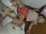 Kinh hoàng: Không đi dép trên nền sân gạch trời nắng, bé 13 tháng bị phỏng rộp 2 bàn chân