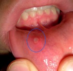 Đây là hiện tượng xuất hiện ở miệng mà 90% người mắc phải có thể là dấu hiệu cảnh báo u.ng th.ư nhưng không ai để ý