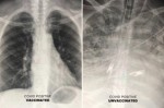 Khác biệt giữa phổi người bệnh Covid-19 đã tiêm vắc xin và chưa tiêm