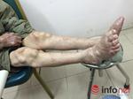 Suy thận vì điều trị gout ở phòng khám đông y Trung Quốc