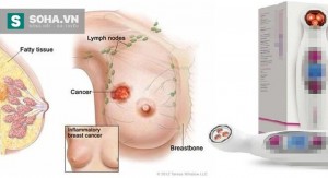 Sự thật máy phát hiện ung thư chỉ dành cho ngực nhỏ ở Việt Nam