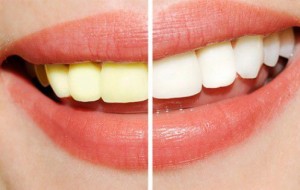 Dùng miếng dán trắng răng: Không cẩn thận mất răng!