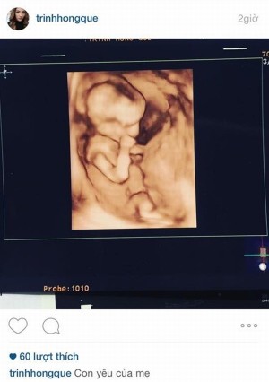 Hồng Quế công khai ảnh siêu âm, úp mở chuyện đang mang thai