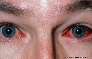 Khóc ra máu vì kính áp tròng kẹt trong mắt suốt 2 năm
