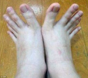 Kỳ lạ cô gái có bàn chân với những ngón dài giống bàn tay