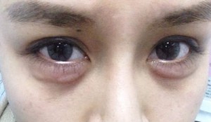 Bi kịch hotgirl suýt mù mắt vì tiêm silicon tạo bọng mắt quyến rũ
