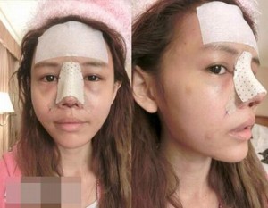 Kinh nghiệm để đời: Nâng mũi rồi phải tháo mũi của cô gái 25 tuổi
