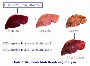 GS Nguyễn Chấn Hùng: Điểm mặt những bệnh ung thư đến từ virus, từ miệng