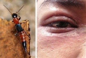 Trúng độc kiến ba khoang gây biến chứng do xử lý sai cách
