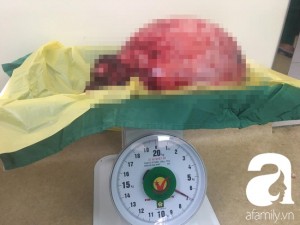 Cứu sống một phụ nữ mang khối u trong tử cung nặng đến…12kg