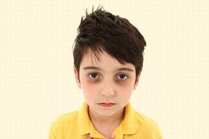 Trẻ nhỏ bị quầng thâm ở mắt cảnh báo bệnh gì?