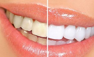 Cao răng bật ra từng mảng ngay lập tức cho răng sáng bóng chỉ với 1 ngàn