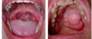 Dấu hiệu ung thư khoang miệng dễ bị bỏ qua
