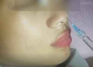TP.HCM: Cô gái khởi kiện cơ sở thẩm mỹ vì hỏng mắt sau tiêm chất làm đầy mũi