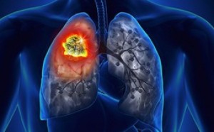 1 triệu chứng cảnh báo ung thư phổi: Phát hiện sớm 90% cơ hội chữa khỏi bệnh