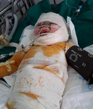 Bé gái 3 tuổi nguy kịch vì ngã vào hố vôi sôi sục: Người mẹ khẩn cầu sự giúp đỡ