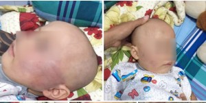 Vĩnh Long: Vì khóc, bé 19 tháng tuổi bị bảo mẫu đánh sưng đỏ