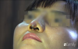 Người phụ nữ bị đứt lìa trụ mũi, chảy dịch và máu sau 12 ngày đi nâng mũi 