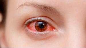Sau đau mắt đỏ, người bệnh cẩn trọng với tổn thương giác mạc