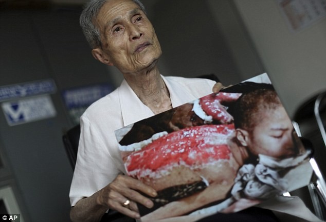 Cơ thể đầy sẹo của nạn nhân bom nguyên tử ở Nhật